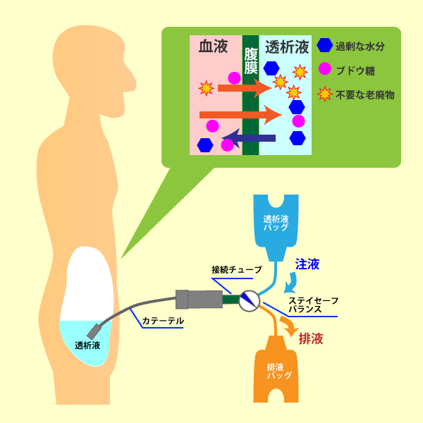 腹膜透析(PD）