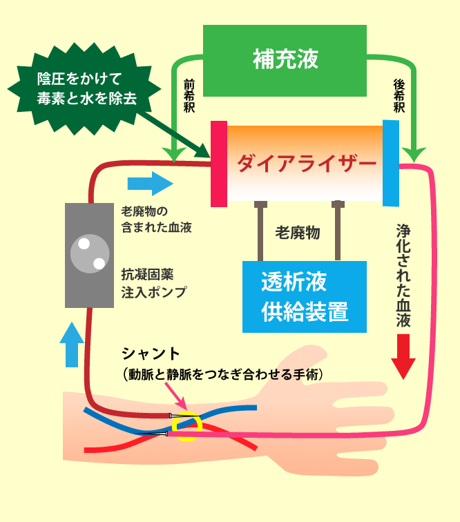 腹膜透析(PD）